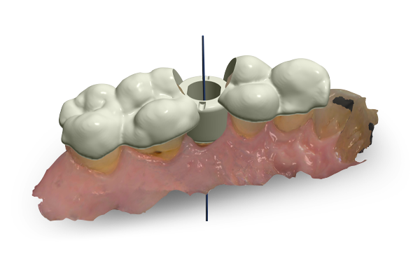 Surgical Planning